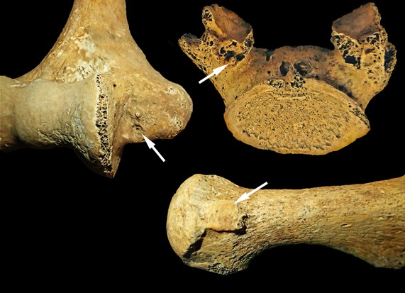The sites of skeletal marks that can indicate lifestyle, Left: Enthesopathy on the humerus associate with repeated throwing. Top right: Fifth lumbar vertebra with complete separation of the vertebral arch from lifting. Bottom right: Extension of the toes from long kneeling